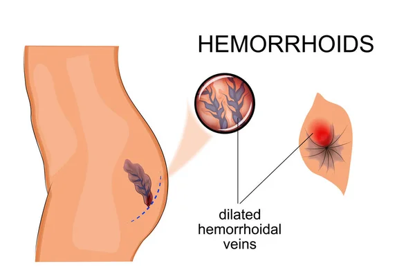 Hemorroides venas dilatadas — Vector de stock
