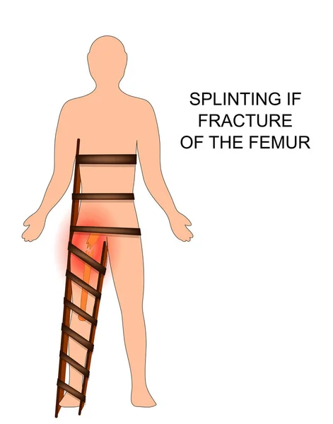 Zlomenina a dlahování stehenní kosti — Stockový vektor