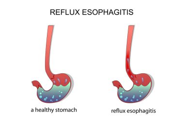 reflux esophagitis stomach.  clipart