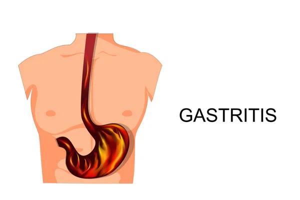 Reflujo esofagitis estomacal . — Vector de stock