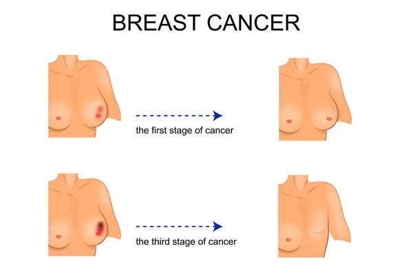 Illustratie voor medische publicaties. carcinoom. chirurgie — Stockvector