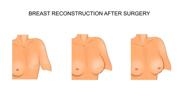 Ilustração para publicações médicas. carcinoma. cirurgia — Vetor de Stock