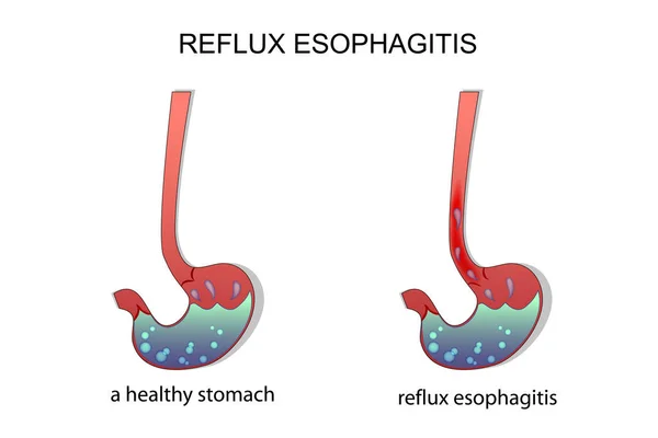 Reflux esophagitis stomach. — Stock Vector