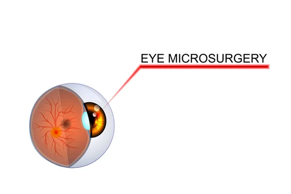 Ilustração do olho, o globo ocular. microcirurgia em oftalmol —  Vetores de Stock