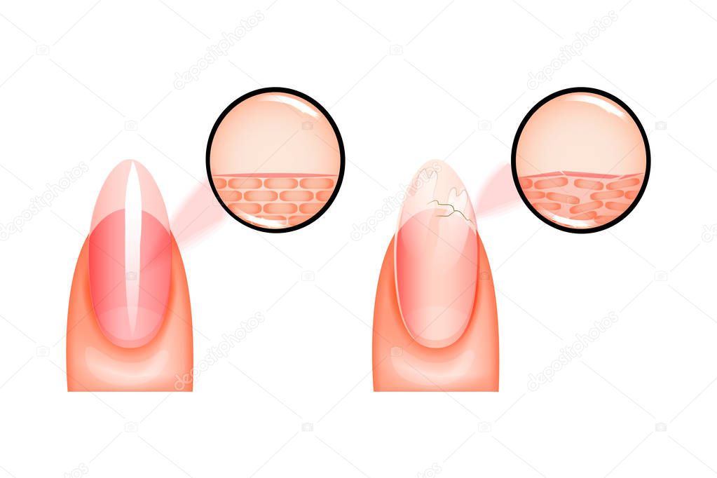 illustration of the nail healthy and sick under magnification