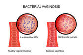 bakterielle Vaginose. die Vagina und der Erreger
