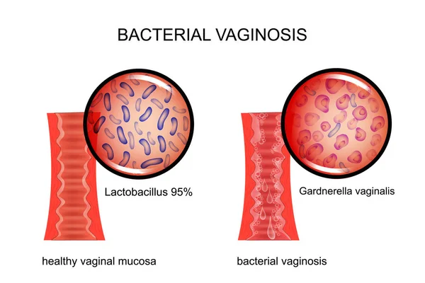 Vaginose bacteriana. a vagina e o agente causador — Vetor de Stock