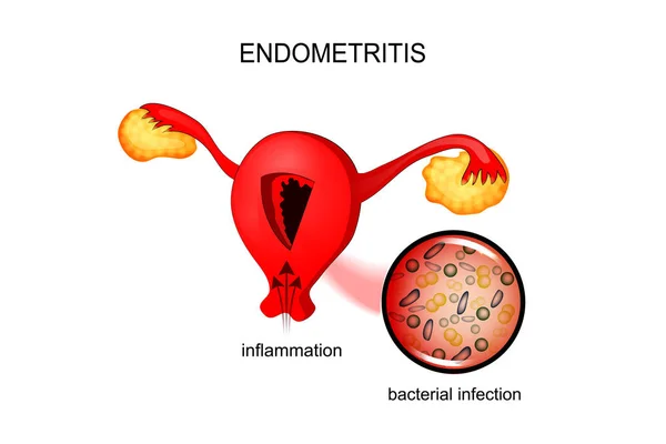 El útero afectado por la endometriosis — Archivo Imágenes Vectoriales