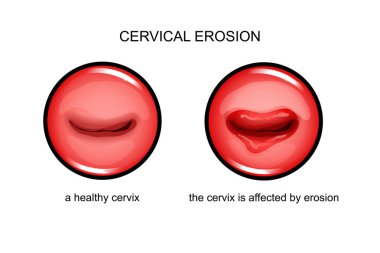 the cervix is affected by erosion clipart