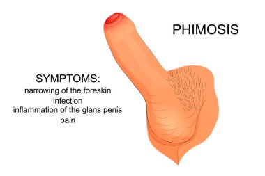 phimosis - narrowing of the foreskin of the penis.