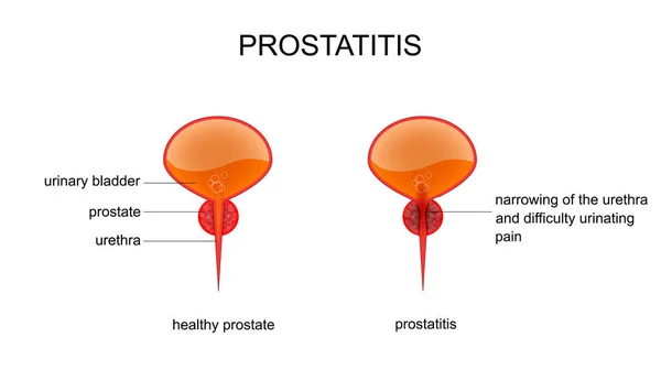 Frisk prostata och prostatit — Stock vektor
