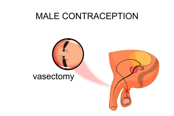 La vasectomía. anticoncepción masculina — Vector de stock