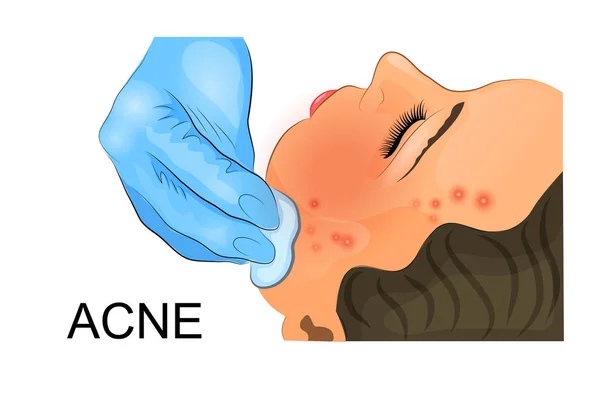 Pulire il viso con un rimedio cosmetico per l'acne — Vettoriale Stock