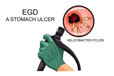 EGD, Gastrik ülser tanısında