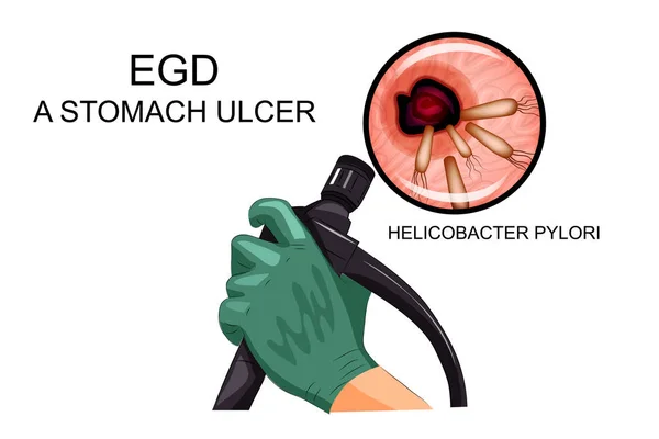 ЭГД, диагностика язвы желудка — стоковый вектор