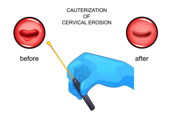 Cauterização da erosão. antes e depois —  Vetores de Stock