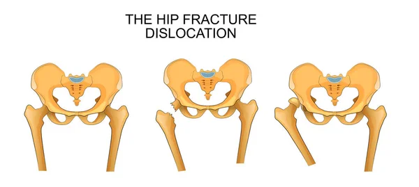 Bassin, fracture de la hanche. luxation de la hanche — Image vectorielle