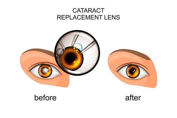 Замена хрусталика в катаракте — стоковый вектор