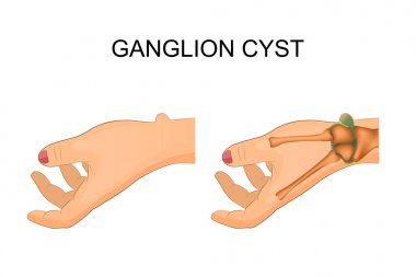 hygroma wrist joint clipart