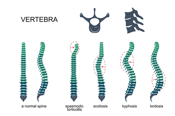 Diseases of the spine — Stock Vector