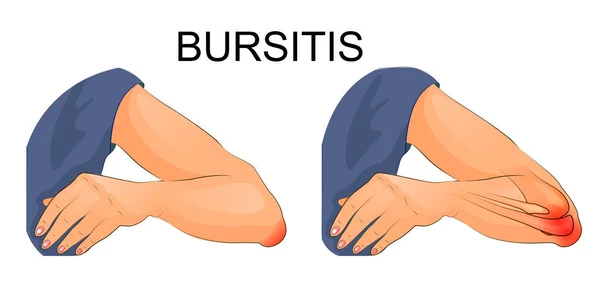 Bursitis of the elbow joint — Stock Vector