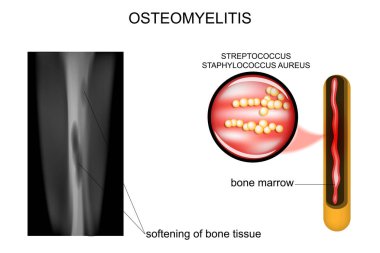 bone lesions osteomyelitis clipart