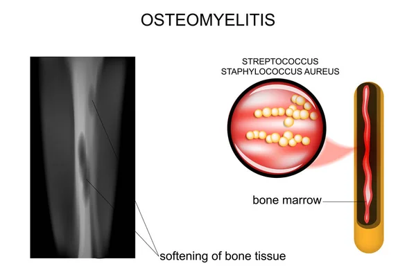 Lesioni ossee osteomielite — Vettoriale Stock