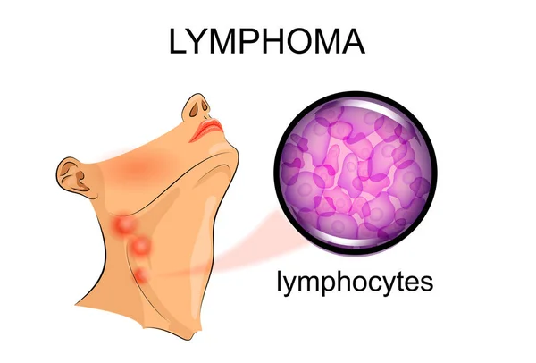 Swollen lymph nodes in lymphoma. Oncology — Stock Vector