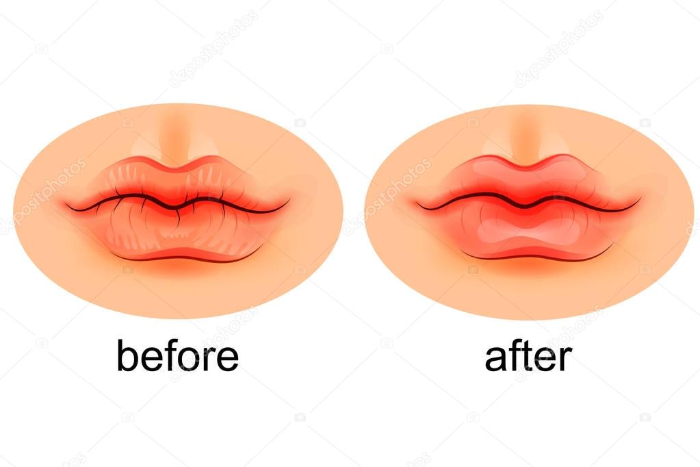 lips are dry and after moistening