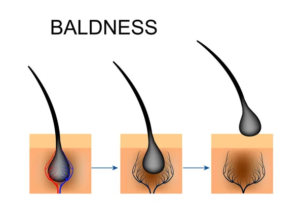 Нарушение кровообращения волосяного фолликула. облысение — стоковый вектор