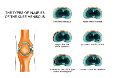 types of meniscus tear clipart