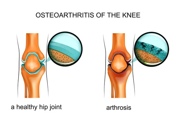 Osteoartrite do joelho — Vetor de Stock