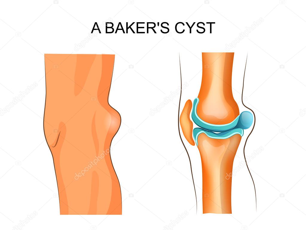 a Baker's cyst
