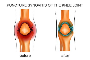 puncture synovitis of the knee joint clipart