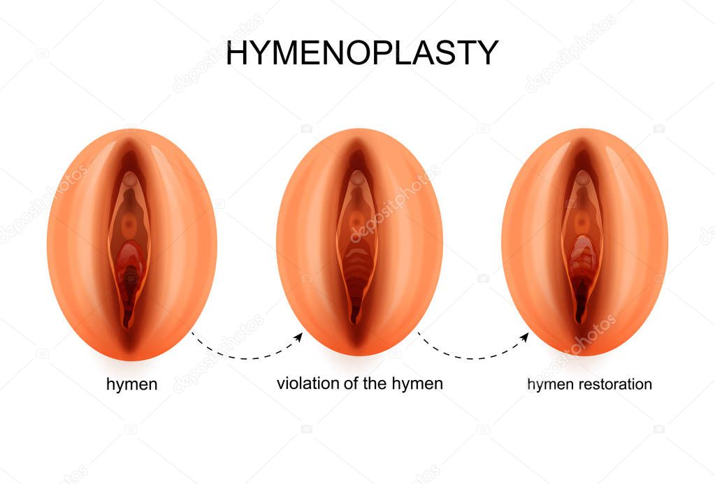 hymen restoration. gynecology