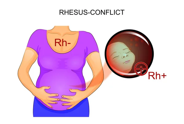 RH-conflit enceinte — Image vectorielle