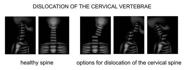Luxación de la columna vertebral — Vector de stock