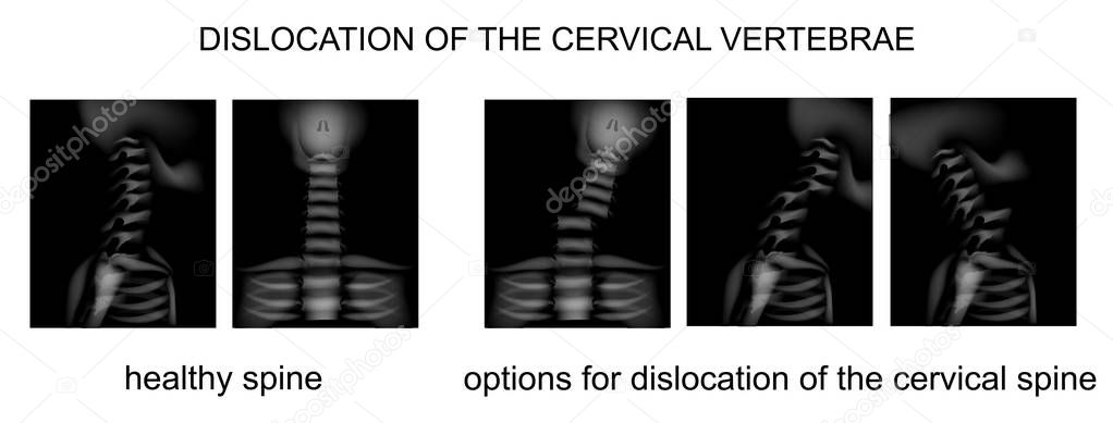 Dislocation of the spine — Stock Illustration Dislocation of the spine Stock Vector