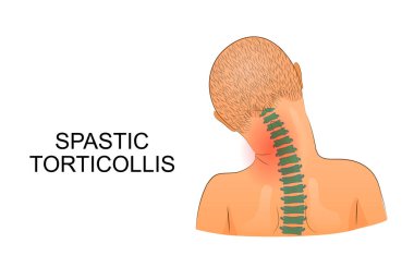 bir çocukta Spastik tortikollis