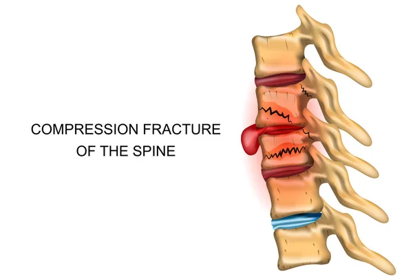 Fracture par compression de la colonne vertébrale — Image vectorielle