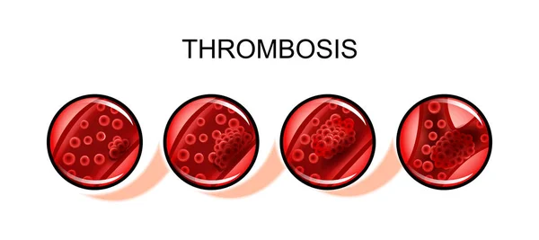 Thromboembolism artery. blockage — Stock Vector