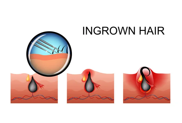 Ingegroeide haren, puistje rijpen — Stockvector