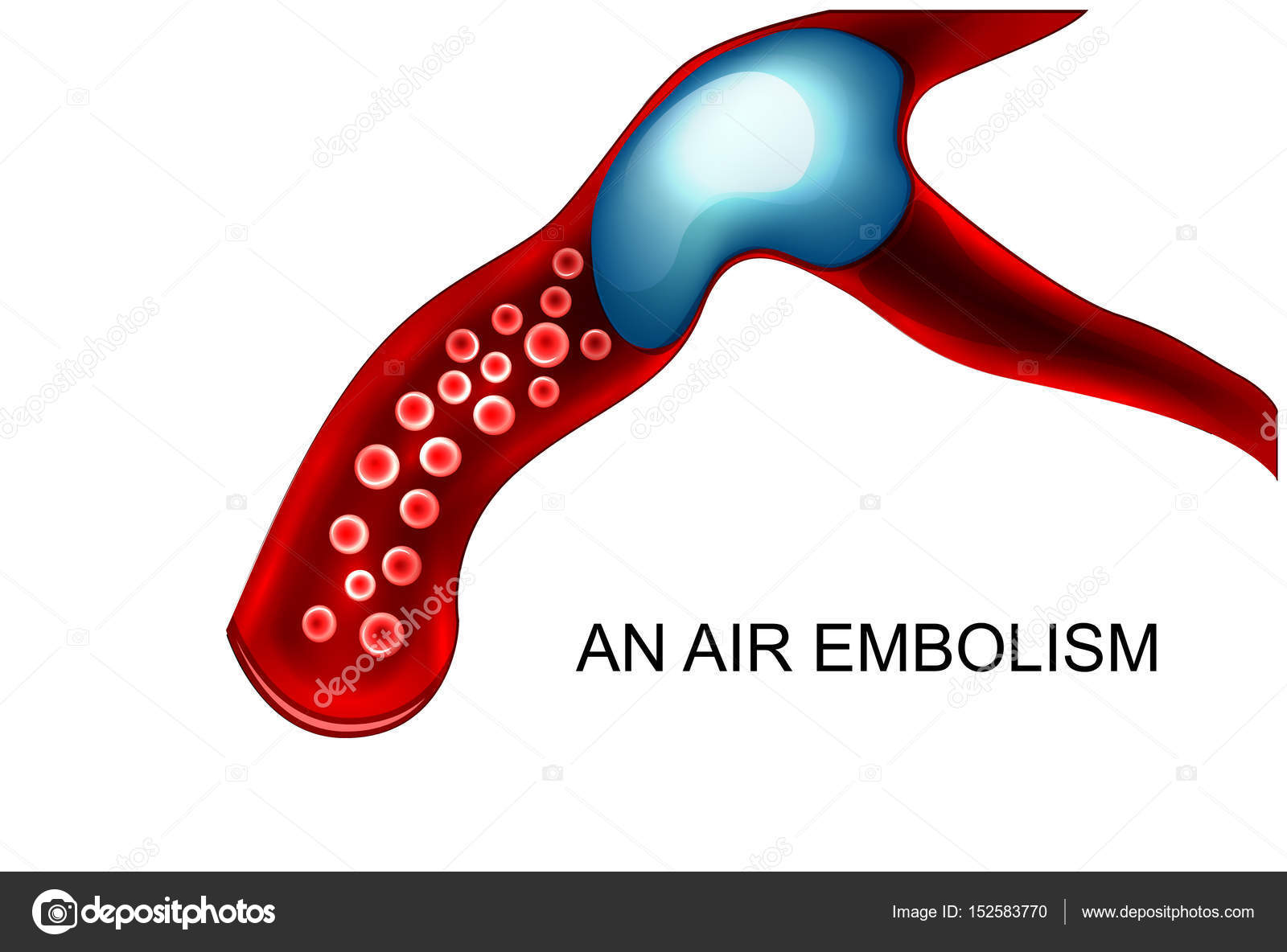 Воздушная эмболия при инъекции. Патогенез воздушной эмболии. Кессонная болезнь воздушная эмболия. Воздушная эмболия сосудов лёгких. Воздушная эмболия сосудов лёгких.