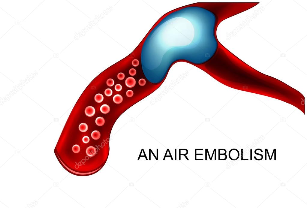 air embolism is a blood vessel