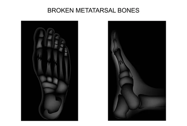 Fracturen van de metatarsale beenderen van de voet — Stockvector