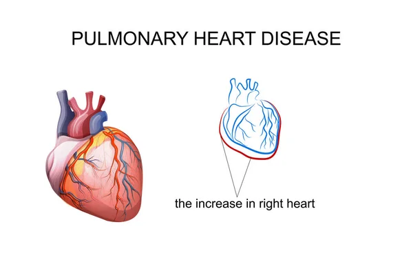 Pulmonalis szívbetegség — Stock Vector