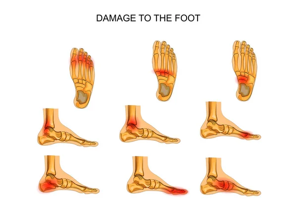 Skada på foten — Stock vektor