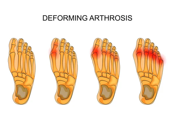 Deformeras artros i foten — Stock vektor