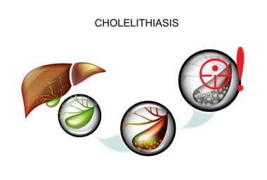 cholelithiasis. hepatic colic clipart