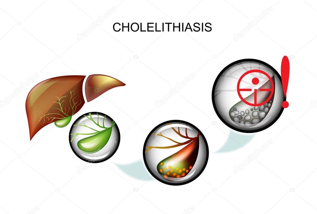 cholelithiasis. hepatic colic